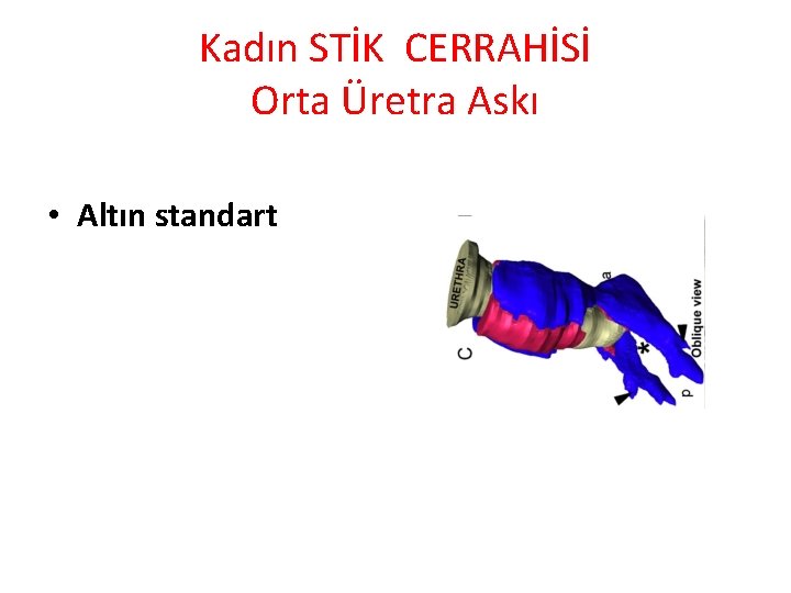 Kadın STİK CERRAHİSİ Orta Üretra Askı • Altın standart 