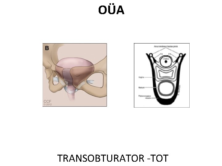 OÜA TRANSOBTURATOR -TOT 