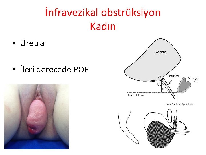 İnfravezikal obstrüksiyon Kadın • Üretra • İleri derecede POP 