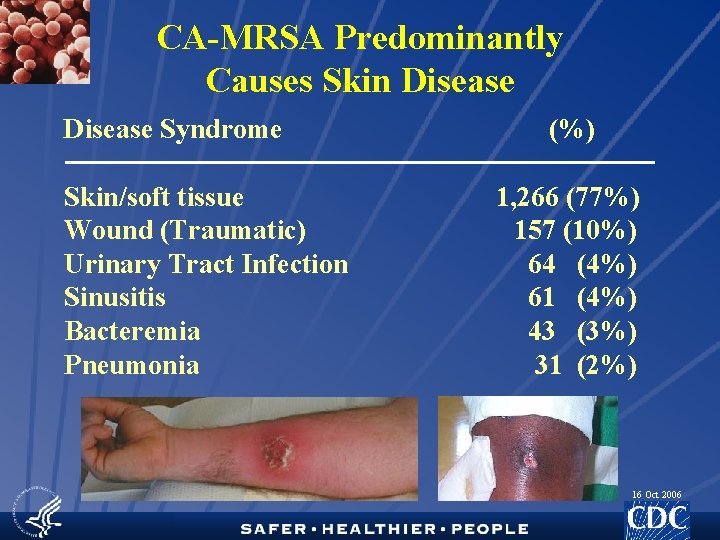 CA-MRSA Predominantly Causes Skin Disease Syndrome Skin/soft tissue Wound (Traumatic) Urinary Tract Infection Sinusitis