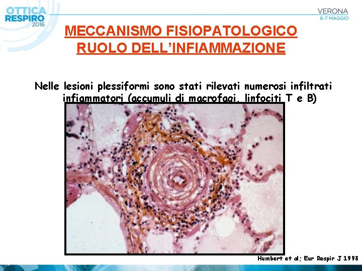 MECCANISMO FISIOPATOLOGICO RUOLO DELL’INFIAMMAZIONE Nelle lesioni plessiformi sono stati rilevati numerosi infiltrati infiammatori (accumuli