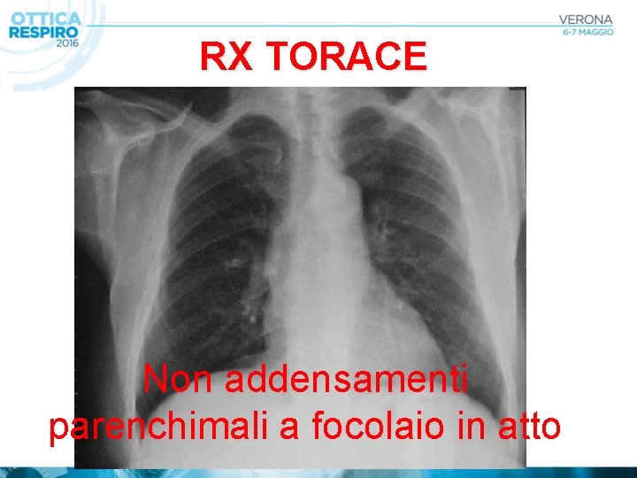 RX TORACE Non addensamenti parenchimali a focolaio in atto 