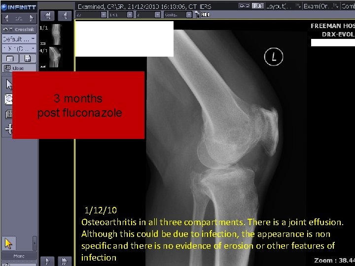 3 months post fluconazole 1/12/10 Osteoarthritis in all three compartments. There is a joint