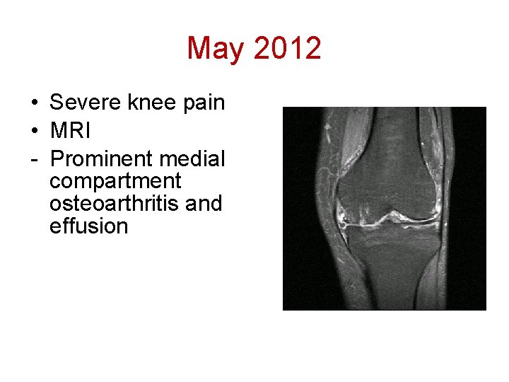 May 2012 • Severe knee pain • MRI - Prominent medial compartment osteoarthritis and