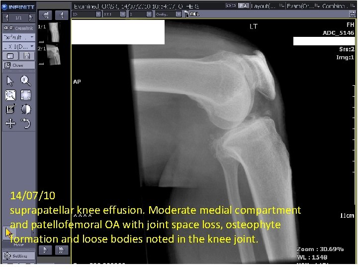 14/07/10 suprapatellar knee effusion. Moderate medial compartment and patellofemoral OA with joint space loss,