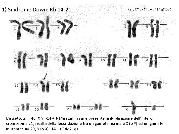 1) Sindrome Down: Rb 14 -21 L’assetto 2 n= 46, X Y: -14 +