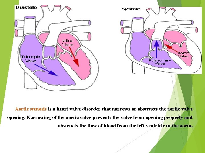 Aortic stenosis is a heart valve disorder that narrows or obstructs the aortic valve Aortic stenosis is a heart valve disorder that narrows or obstructs the aortic valve