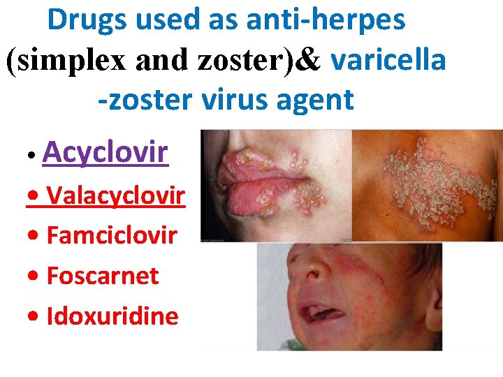 Drugs used as anti-herpes (simplex and zoster)& varicella -zoster virus agent • Acyclovir •