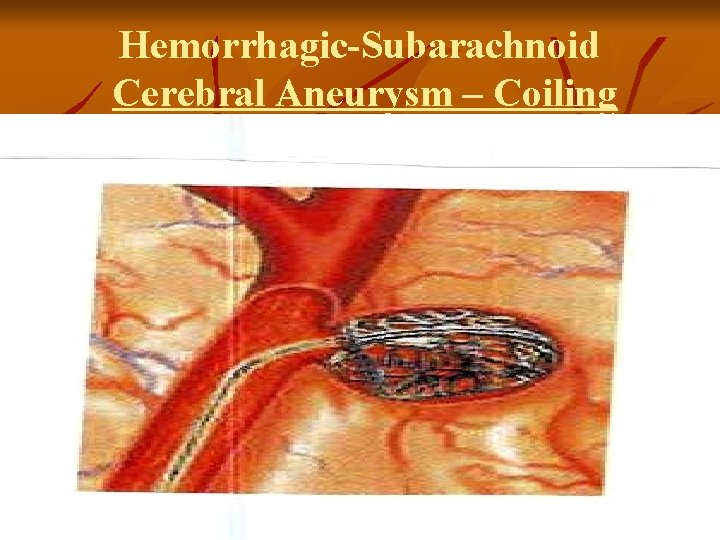 Hemorrhagic-Subarachnoid Cerebral Aneurysm – Coiling 