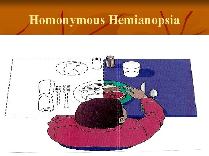 Homonymous Hemianopsia 