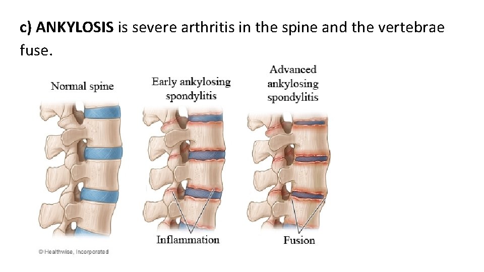 c) ANKYLOSIS is severe arthritis in the spine and the vertebrae fuse. 