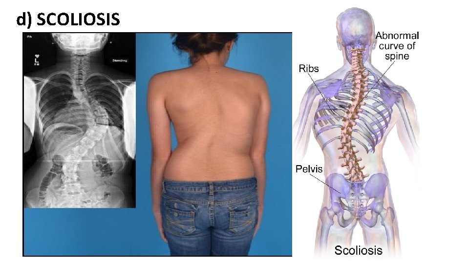 d) SCOLIOSIS 