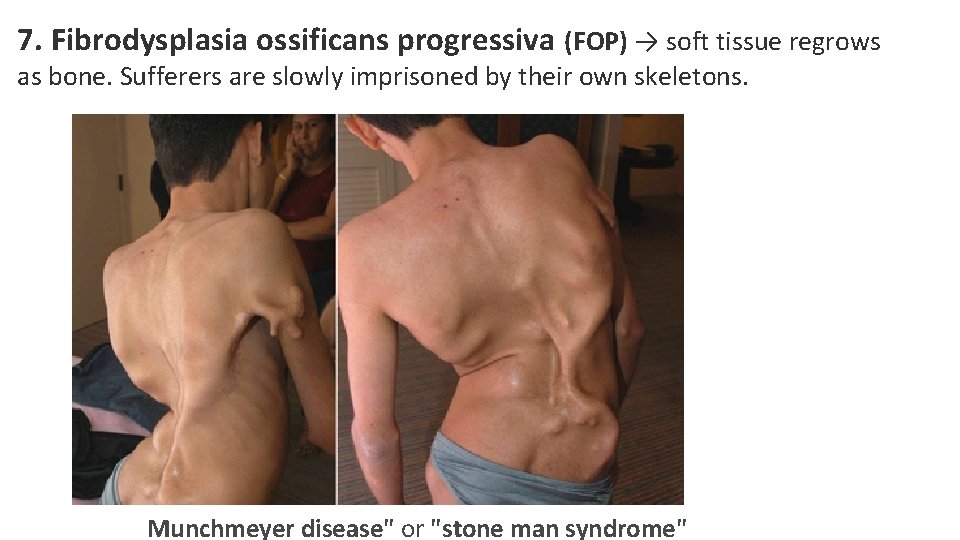 7. Fibrodysplasia ossificans progressiva (FOP) → soft tissue regrows as bone. Sufferers are slowly