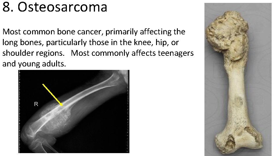 8. Osteosarcoma Most common bone cancer, primarily affecting the long bones, particularly those in