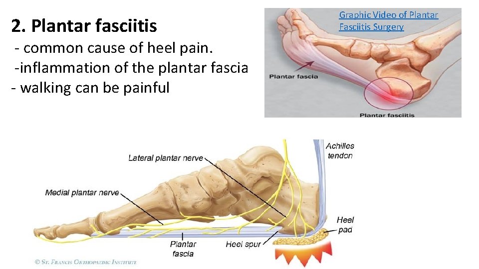 2. Plantar fasciitis - common cause of heel pain. -inflammation of the plantar fascia