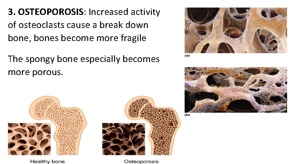 3. OSTEOPOROSIS: Increased activity of osteoclasts cause a break down bone, bones become more