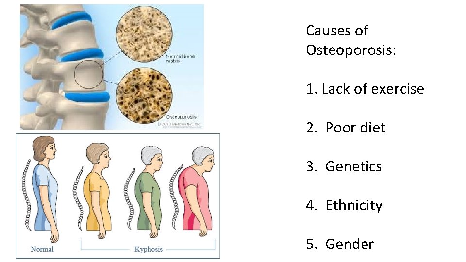 Causes of Osteoporosis: 1. Lack of exercise 2. Poor diet 3. Genetics 4. Ethnicity