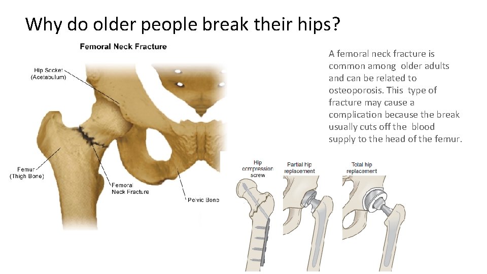 Why do older people break their hips? A femoral neck fracture is common among