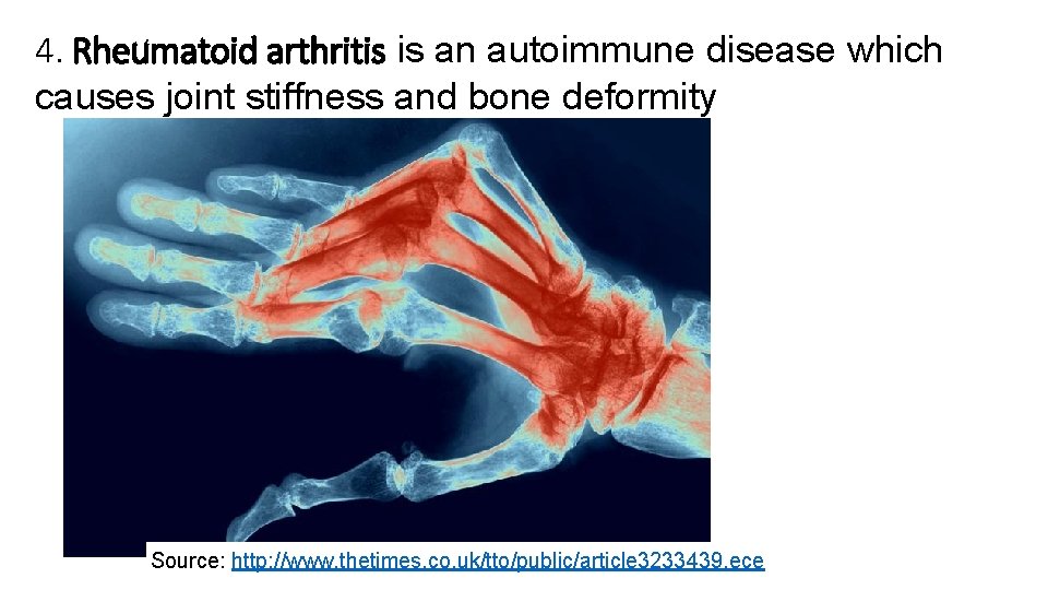 4. Rheumatoid arthritis is an autoimmune disease which causes joint stiffness and bone deformity