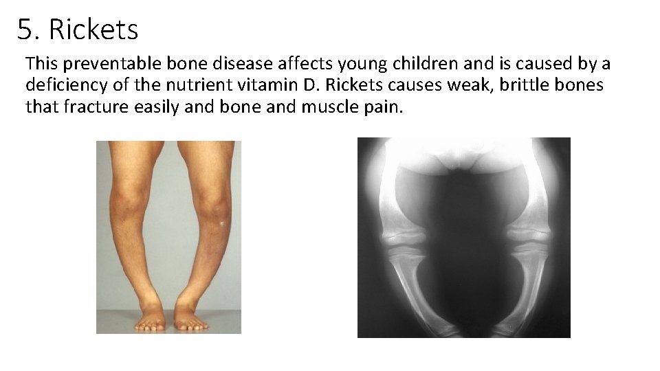 5. Rickets This preventable bone disease affects young children and is caused by a