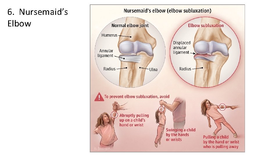 6. Nursemaid’s Elbow 