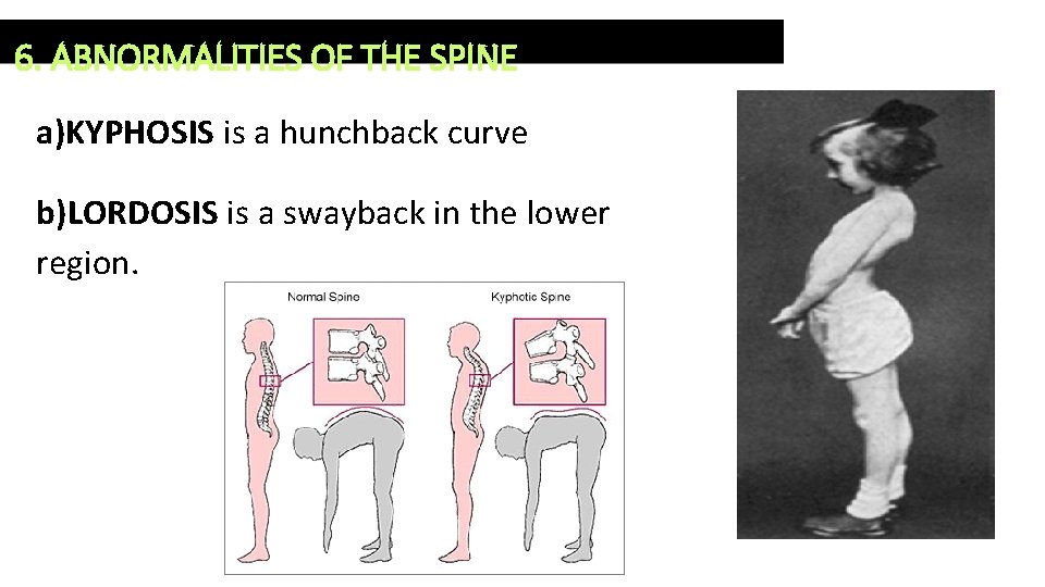 6. ABNORMALITIES OF THE SPINE a)KYPHOSIS is a hunchback curve b)LORDOSIS is a swayback