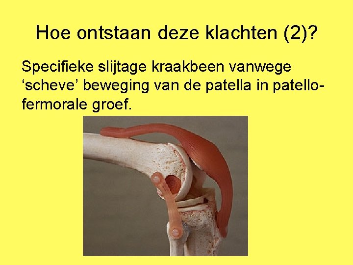 Hoe ontstaan deze klachten (2)? Specifieke slijtage kraakbeen vanwege ‘scheve’ beweging van de patella