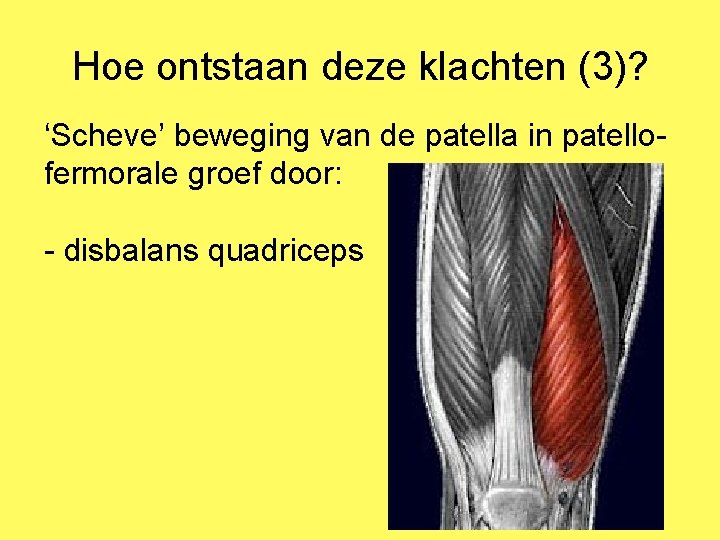 Hoe ontstaan deze klachten (3)? ‘Scheve’ beweging van de patella in patellofermorale groef door: