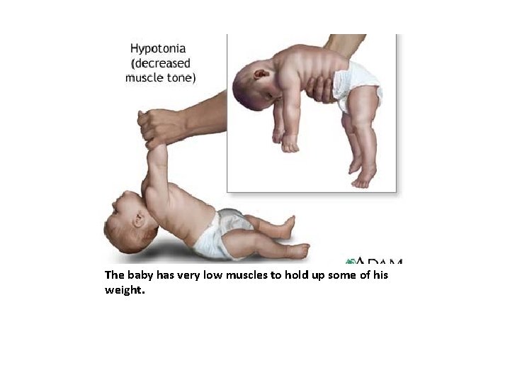 The baby has very low muscles to hold up some of his weight. 