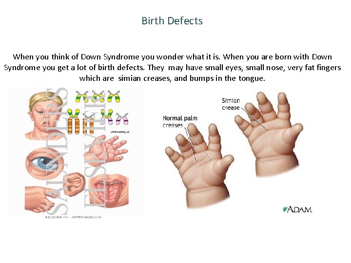 Birth Defects When you think of Down Syndrome you wonder what it is. When