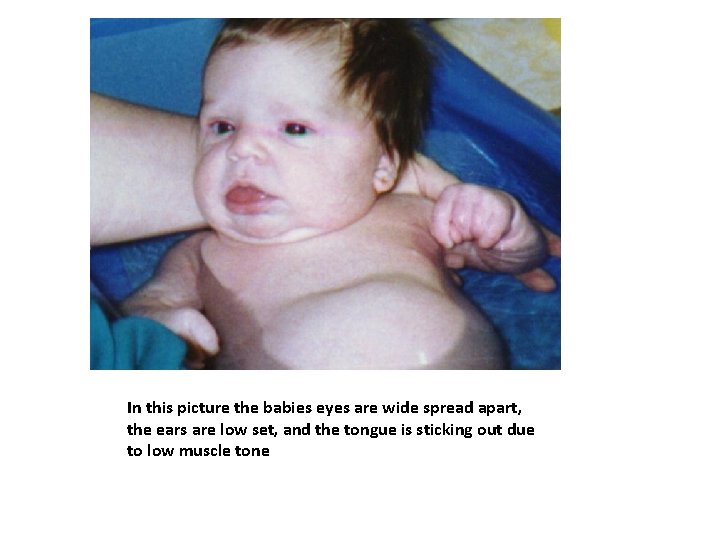 In this picture the babies eyes are wide spread apart, the ears are low