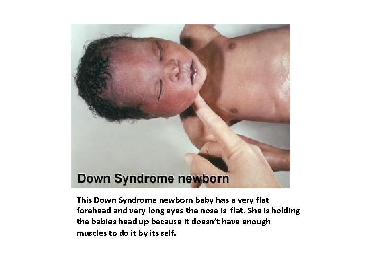 This Down Syndrome newborn baby has a very flat forehead and very long eyes