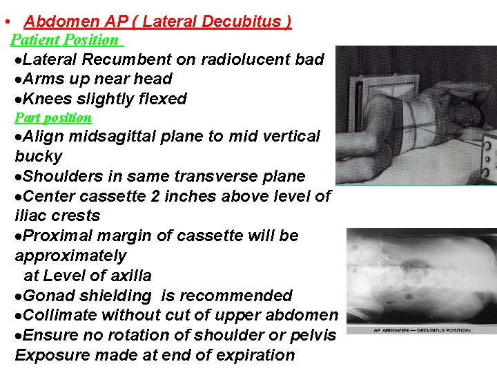  • Abdomen AP ( Lateral Decubitus ) Patient Position Lateral Recumbent on radiolucent