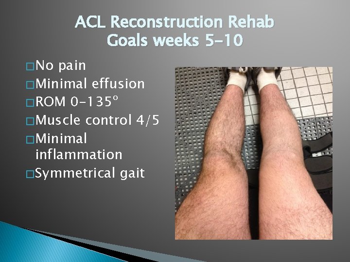 ACL Reconstruction Rehab Goals weeks 5 -10 � No pain � Minimal effusion �