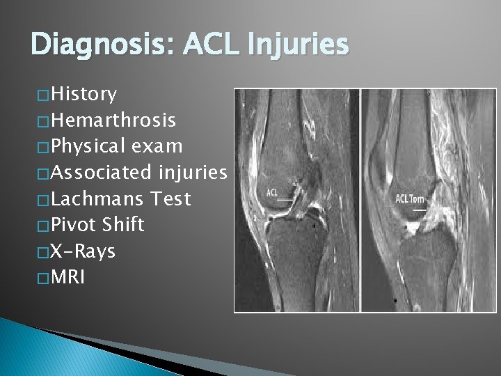 Diagnosis: ACL Injuries � History � Hemarthrosis � Physical exam � Associated injuries �