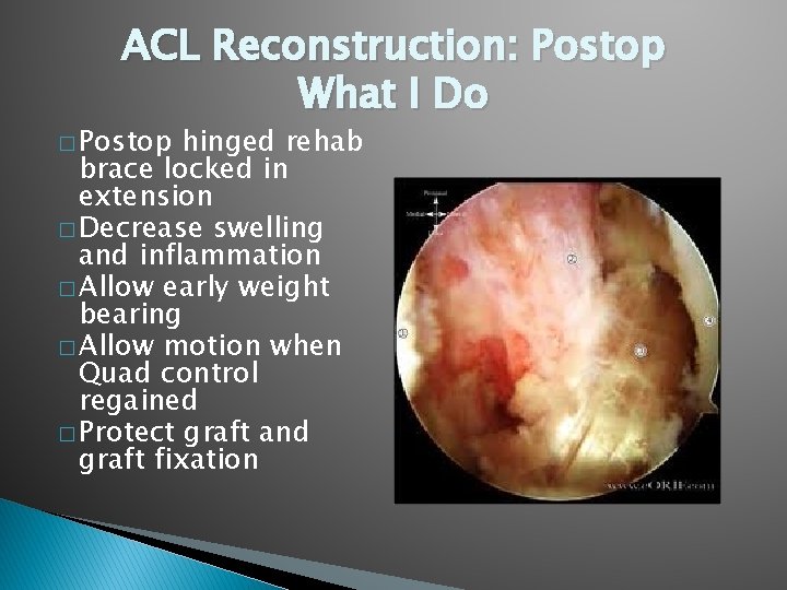 ACL Reconstruction: Postop What I Do � Postop hinged rehab brace locked in extension