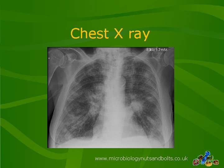 Chest X ray www. microbiologynutsandbolts. co. uk 