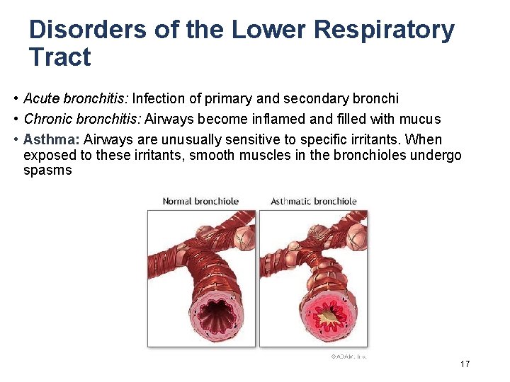 Disorders of the Lower Respiratory Tract • Acute bronchitis: Infection of primary and secondary