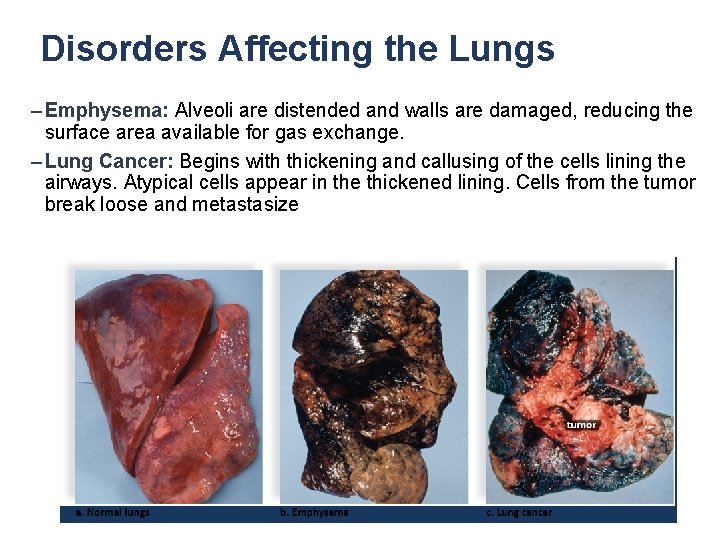 Disorders Affecting the Lungs – Emphysema: Alveoli are distended and walls are damaged, reducing