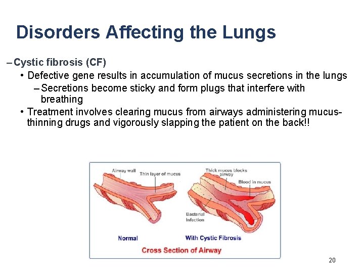 Disorders Affecting the Lungs – Cystic fibrosis (CF) • Defective gene results in accumulation