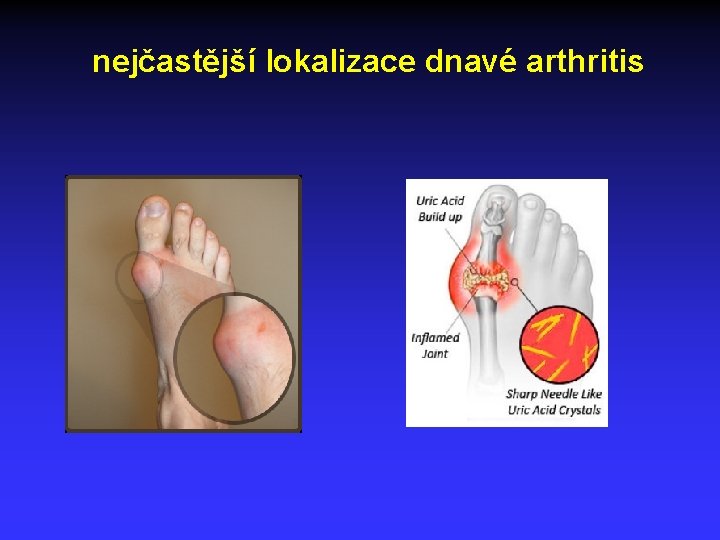 nejčastější lokalizace dnavé arthritis 