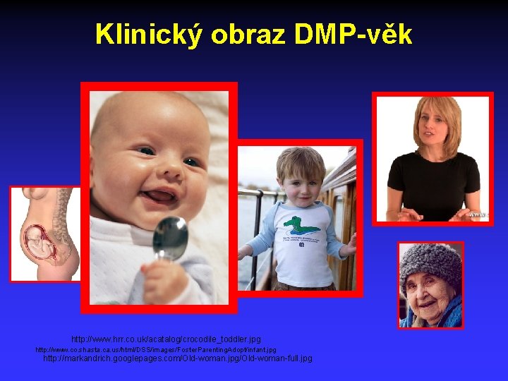 Klinický obraz DMP-věk http: //www. hrr. co. uk/acatalog/crocodile_toddler. jpg http: //www. co. shasta. ca.