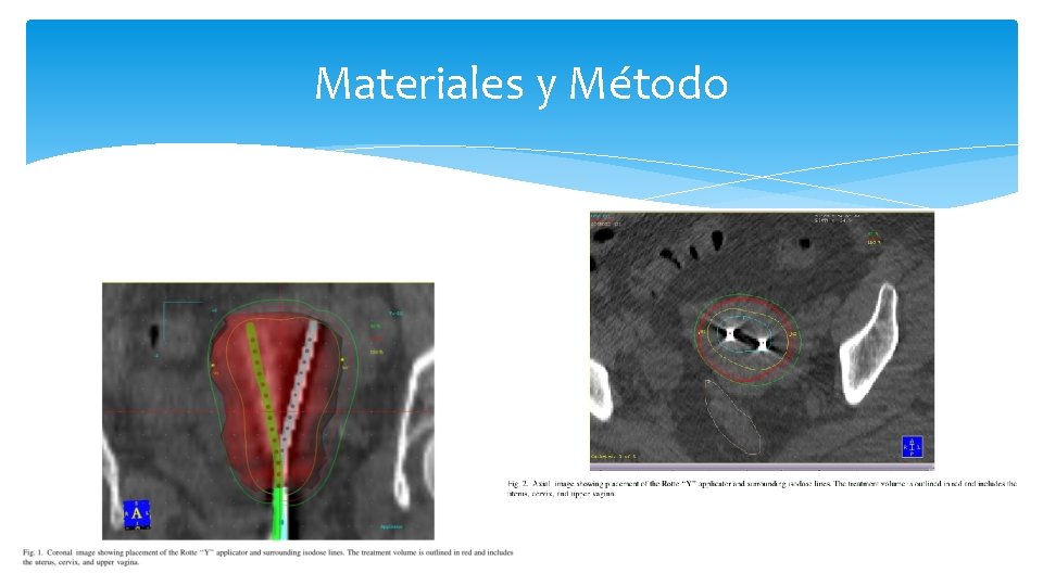 Materiales y Método 