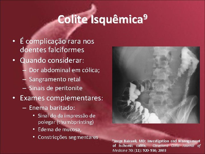 Colite Isquêmica 9 • É complicação rara nos doentes falciformes • Quando considerar: –