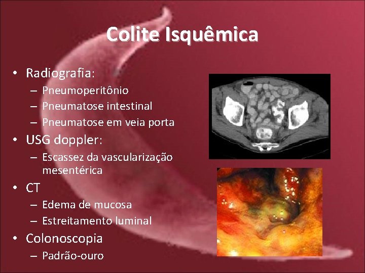 Colite Isquêmica • Radiografia: – Pneumoperitônio – Pneumatose intestinal – Pneumatose em veia porta