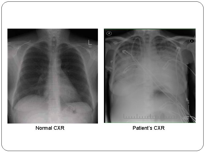 Normal CXR Patient’s CXR 