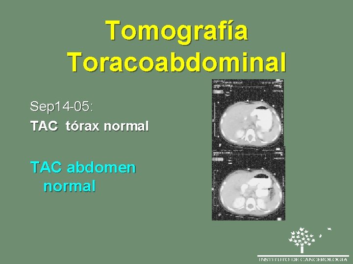 Tomografía Toracoabdominal Sep 14 -05: TAC tórax normal TAC abdomen normal 