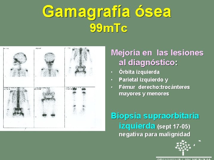 Gamagrafía ósea 99 m. Tc Mejoría en las lesiones al diagnóstico: • • •