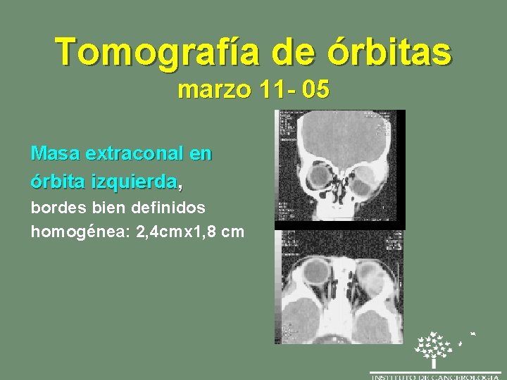 Tomografía de órbitas marzo 11 - 05 Masa extraconal en órbita izquierda, bordes bien