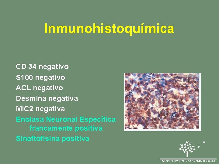 Inmunohistoquímica CD 34 negativo S 100 negativo ACL negativo Desmina negativa MIC 2 negativa